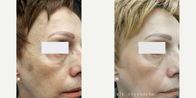 ProFractional Laser before and after photo