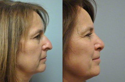 Rhinoplasty before and after photo