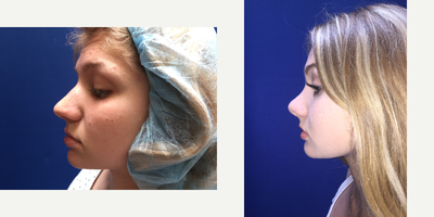 Rhinoplasty before and after photo