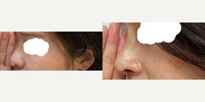 Asian Rhinoplasty before and after photo