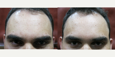 Botox before and after photo