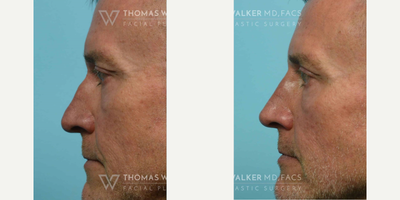 Botox before and after photo