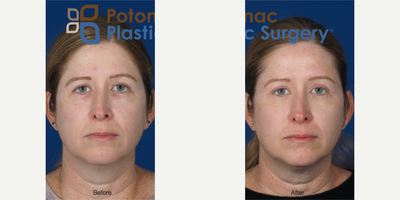 Brow Lift before and after photo