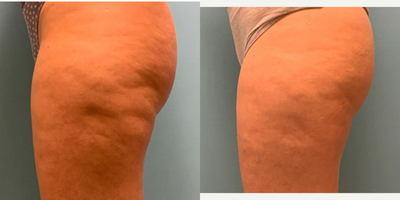 Cellfina before and after photo