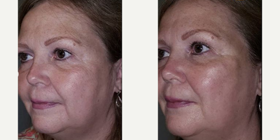Dermal Fillers before and after photo