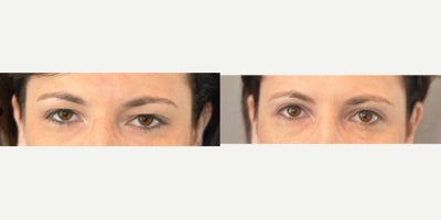 Eyelid Surgery before and after photo