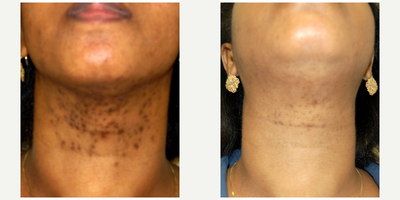 Laser Hair Removal before and after photo