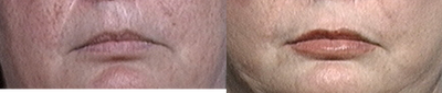 Lip Fillers before and after photo