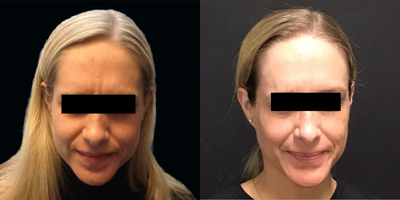 Botox before and after photo