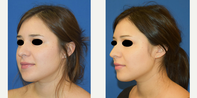 Buccal Fat Removal before and after photo