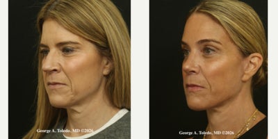 Facelift before and after photo