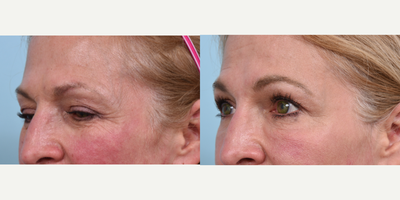 Liquid Facelift before and after photo