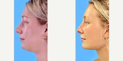 Neck Lift before and after photo