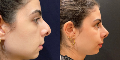 Revision Rhinoplasty before and after photo