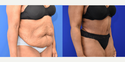 Tummy Tuck before and after photo