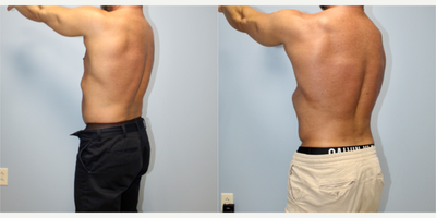 Vaser Liposuction before and after photo