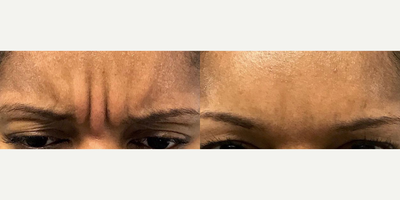 Botox before and after photo