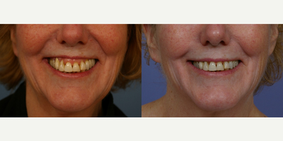 Botox before and after photo