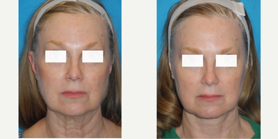 Neck Lift before and after photo