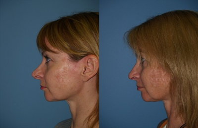 Revision Rhinoplasty before and after photo