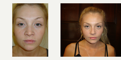 Rhinoplasty before and after photo