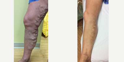 Sclerotherapy before and after photo