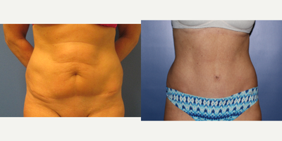Tummy Tuck before and after photo