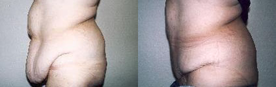 Body Lift before and after photo