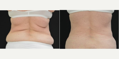 CoolSculpting before and after photo