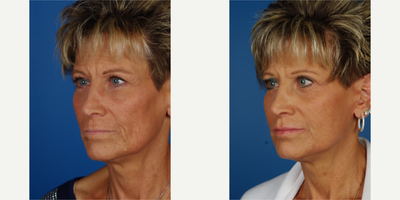 Facelift before and after photo