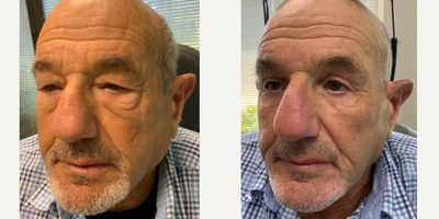 Ptosis Surgery before and after photo