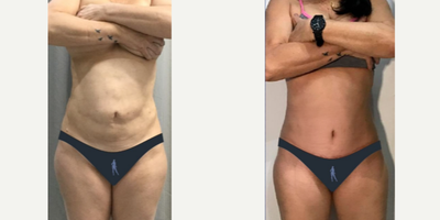 Smart Lipo before and after photo