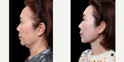 Chin Liposuction before and after photo