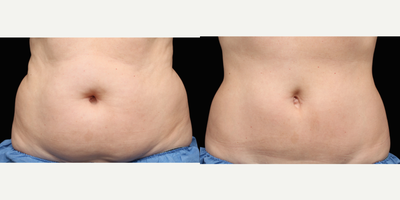 CoolSculpting before and after photo