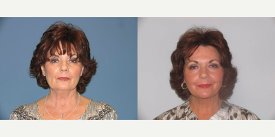 Facelift before and after photo