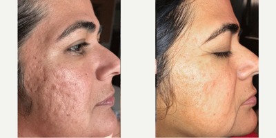 Laser Scar Removal before and after photo