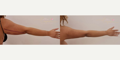 Liposuction before and after photo