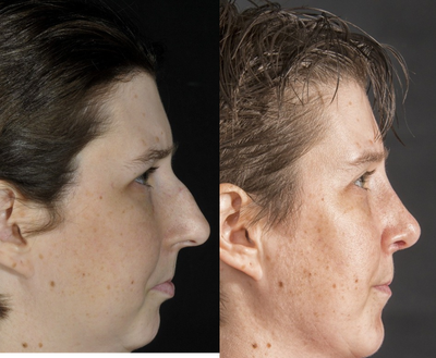Rhinoplasty before and after photo