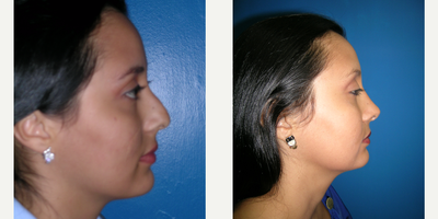 Rhinoplasty before and after photo
