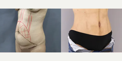 Tummy Tuck before and after photo