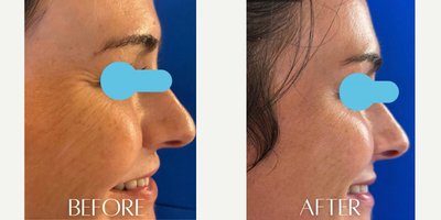Botox before and after photo
