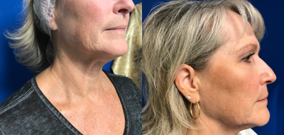Profound RF before and after photo