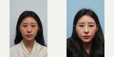 Asian Rhinoplasty before and after photo