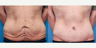Body Lift before and after photo