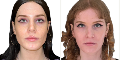 Botox for TMJ before and after photo
