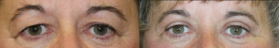 Eyelid Surgery before and after photo
