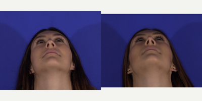 Rhinoplasty before and after photo