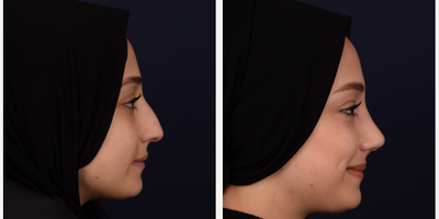Rhinoplasty before and after photo