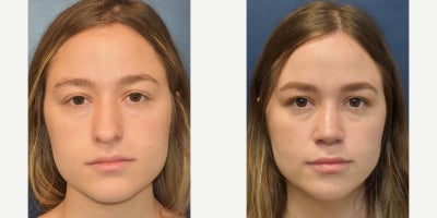 Septoplasty before and after photo