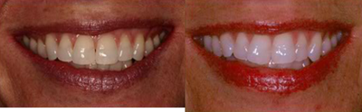 Teeth Whitening before and after photo